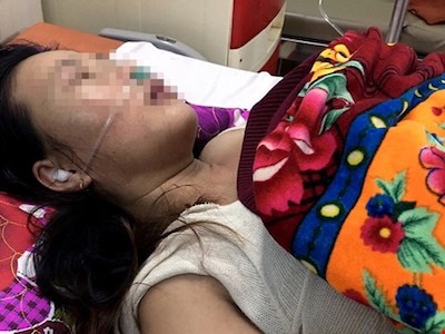 Chồng đánh vợ tổn thương sọ não, nhập viện cấp cứu