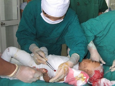 Mẹ sơ sẩy, con 14 tháng tuổi ngã vào nồi canh vừa sôi gây bỏng nặng