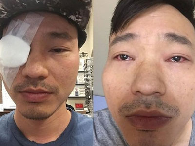 Cựu thành viên AC&M sợ bị mù vì rách võng mạc vô cùng nghiêm trọng