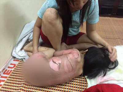 Em bé bị bỏng toàn thân khi tắm và lời cảnh tỉnh cho bố mẹ