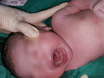 TP.HCM: Một bé gái mới sinh đã mọc... 2 răng cửa