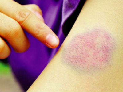 Dấu hiệu nhận biết sớm ung thư máu