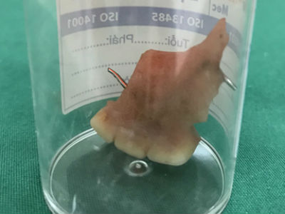 Nam thanh niên nhập viện sau tiệc cưới vì... lỡ nuốt 3 chiếc răng giả