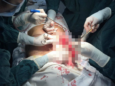 Lại thẩm mỹ hỏng: Nâng ngực sau sinh, con không thể bú còn mẹ phải phẫu thuật vì "chảy" silicon