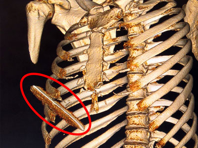 Thanh niên bị lưỡi dao 10 cm đâm lút ngực, thủng gan vẫn may mắn thoát chết