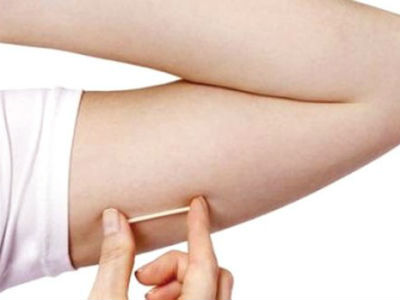 Lợi hại khi ngừa thai bằng que cấy dưới da