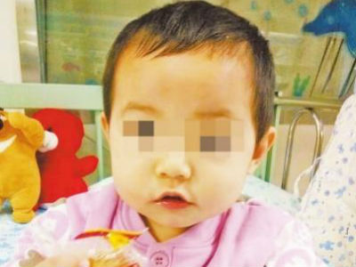 Bé gái 2 tuổi bị đũa cắm vào mắt, chạm tới sọ khi đang ăn cơm