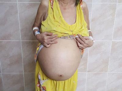 Cứu sống một phụ nữ mang khối u trong tử cung nặng đến…12kg