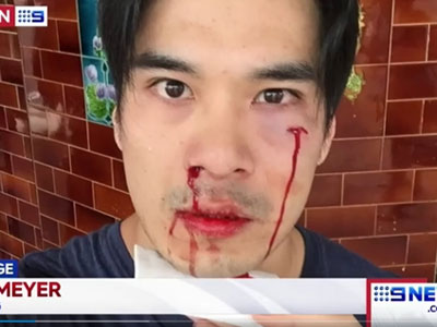 Diễn viên Thiên Nguyễn bị đánh trên đường phố Australia