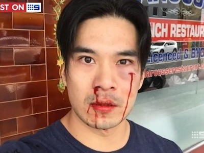 Diễn viên gốc Việt bị đánh mẻ răng, chảy máu mũi ở Australia
