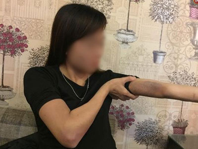 Nỗi kinh hoàng của cô gái sau khi bị bạn trai đánh dã man, thâm tím hết cả người