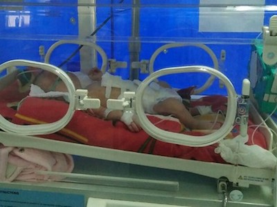 Bé sơ sinh bị thủng ruột từ trong bụng mẹ