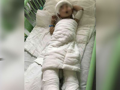 Mẹ cạo đầu, lột da để cứu con trai 2 tuổi bị bỏng nặng vì ngã vào nồi nước sôi