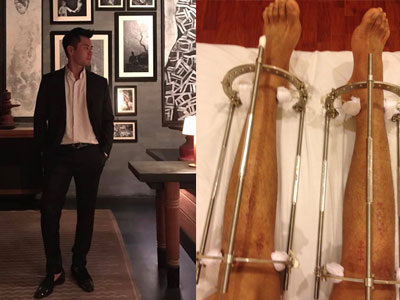 Nhật ký kéo dài chân từ 1m67 đến 1m76 (9 cm) của chàng trai Hà Nội
