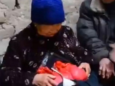 Khó tin cụ bà sống suốt 20 năm với... ruột lòi ra ngoài cơ thể