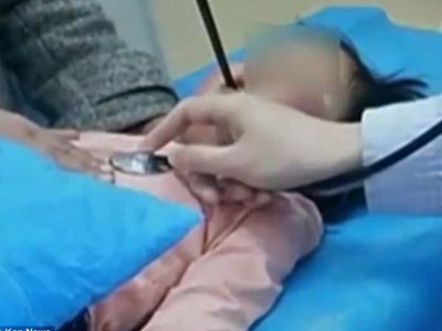 Bé gái sống sót kỳ diệu khi bị đũa đâm từ miệng xuyên thẳng lên não 4cm