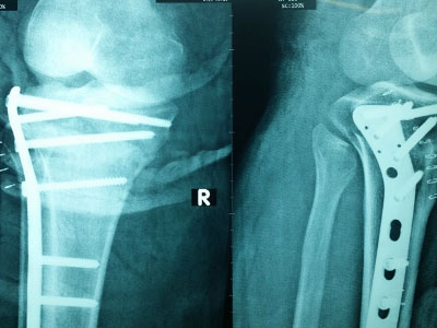 Bác sĩ bỏ qua xét nghiệm kịp mổ cứu chân bệnh nhân