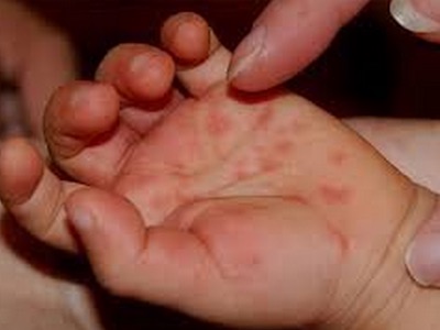 Một em bé tử vong do bệnh tay chân miệng trong ngày mùng 1 Tết