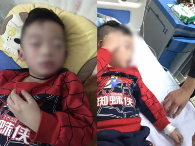 Hà Nội: Tin đồn bé trai sưng vù mặt phải cấp cứu vì uống trà sữa, bệnh viện Nhi TW nói gì?