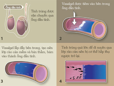 Loại thuốc giúp đàn ông tránh thai trong 2 năm