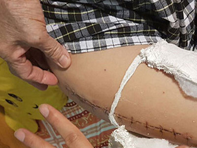 Phụ huynh có con bị gãy chân tại trường: Báo cáo của hiệu trưởng là dối trá