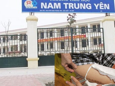 Giáo viên chủ nhiệm học sinh gãy chân tiết lộ thông tin "sốc"