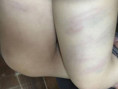 Sa thải giáo viên dùng đũa đánh thâm tím hai chân bé gái