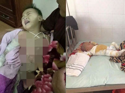 Mẹ bất cẩn, con trai 2 tuổi ngã vào nồi nước sôi bỏng toàn thân