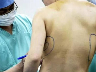 Sau 10 năm thẩm mỹ, người phụ nữ cay đắng gỡ miếng độn ngực đang dần trôi về sau lưng