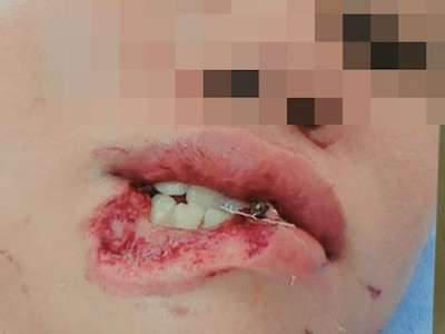 Cô ruột cắn cháu gái đứt lìa 1/3 môi