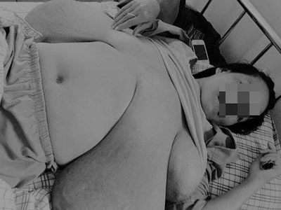Người phụ nữ bỗng có ngực "khủng" dài đến đầu gối sau lần mang thai thứ 2