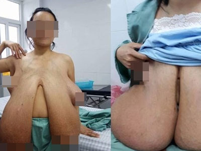 Người đàn bà có bộ ngực lớn bất thường ở VN: "Tôi khổ lắm, chẳng làm được gì vì ngực nặng"