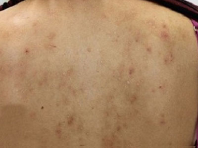 Vì sao nhiều người hay bị mụn trứng cá ở lưng và ngực?