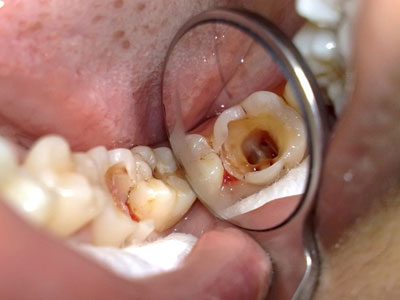 Dù chỉ đau răng thoáng qua, đừng coi thường: Đây có thể là lời cảh báo bệnh nguy hiểm