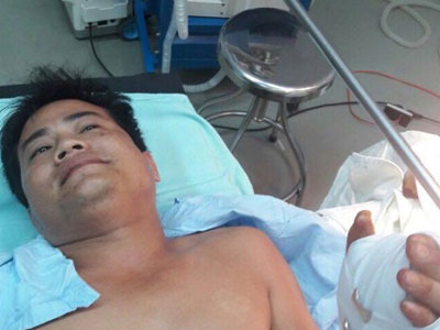 Nghịch súng bút, nam thanh niên bị đạn bắn thủng bàn tay