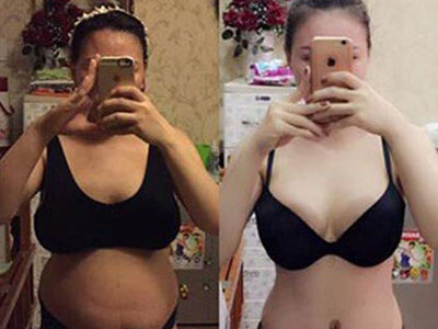 Cắt phăng 2 tảng mỡ bụng để giảm cân có nguy hiểm?