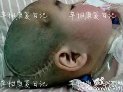 Quấy khóc khi mẹ đẻ cùng nhân tình ân ái, bé gái bị ngược đãi, hôn mê 545 ngày chưa tỉnh