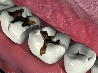 Chỉ vì một cái răng sâu mà tử vong, đừng chủ quan trong điều trị
