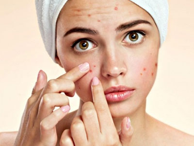 Bị trứng cá bôi thuốc gì?