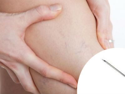 Bị suy tĩnh mạch không nên chích lể nặn máu