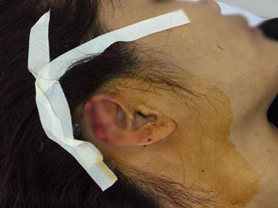 Giáo viên dạy khiêu vũ thể thao tố bị phụ huynh học sinh cũ cắn đứt tai