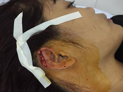 Vụ cô giáo bị phụ huynh cắn đứt tai: Công an vào cuộc làm rõ nghi vấn