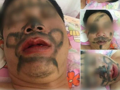 Người vợ vẽ chằng chịt lên mặt chồng vì nhiều lần nhậu say