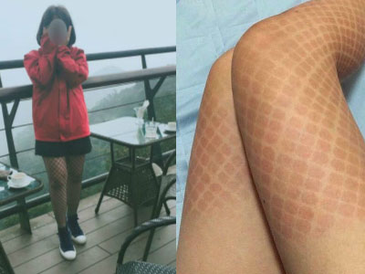 Mới chớm hè, chị em đã đau đớn tự biến mình thành "khô mực" vì tất lưới như thế này