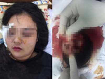 Vụ cô gái bị 20 thanh niên đánh dã man vì tố giác trộm xe: Mắt trái nạn nhân có nguy cơ mù hoàn toàn
