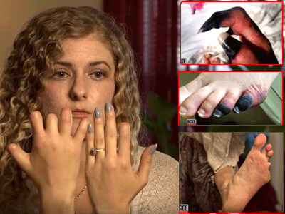 Cô gái mất 6 ngón tay và 2 ngón chân chỉ sau một cơn đau họng ngỡ rất bình thường