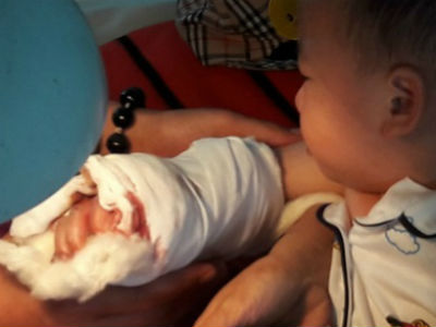 Sơ cứu đúng cách khi gặp tai nạn làm dập nát, đứt lìa chi