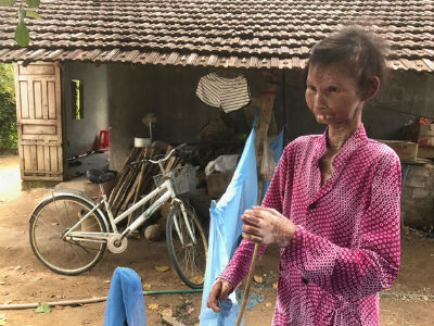 Nàng sơn nữ biến thành bà già vì bệnh lạ