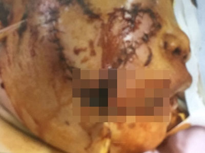 Thương tâm bé gái 5 tuổi bị chó cắn nát nửa khuôn mặt, lộ cả hai hàm răng