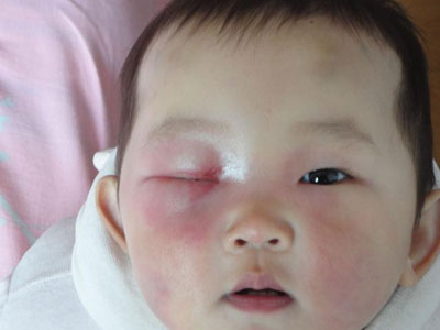 Bé gái 7 tháng tuổi suýt mù vì mẹ tự cắt lông mi. Có thể bạn cũng đang làm thế với con mình...
